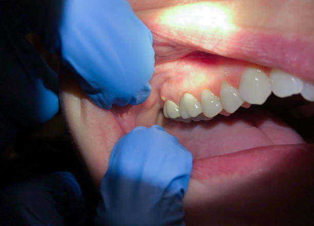 Best Tooth Infection Emergency Dentist  in Ashley, PA