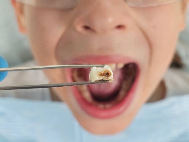 Best Chipped Tooth Repair Near Me  in Ashley, PA